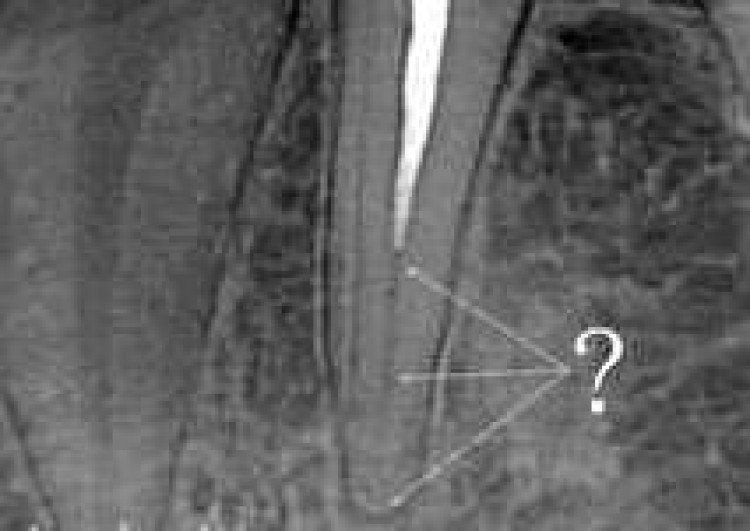 How does NOT have to look like root canal treated tooth on x-ray record?