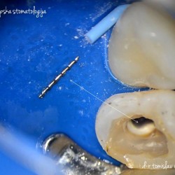 Removal of broken instrument from root canal under microscope