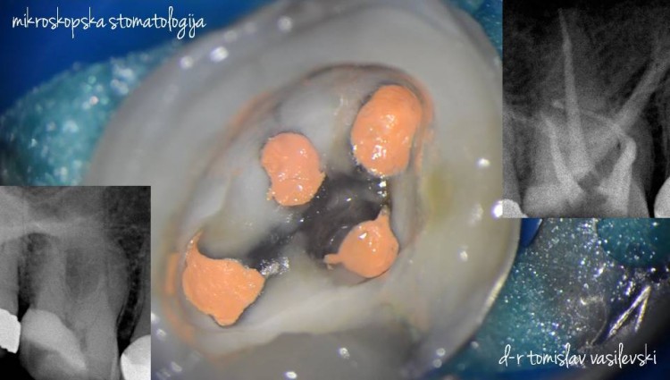 The latest contemporary treatment of root canals under microscope – “root canal therapy”