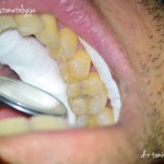 пломбирање на заби