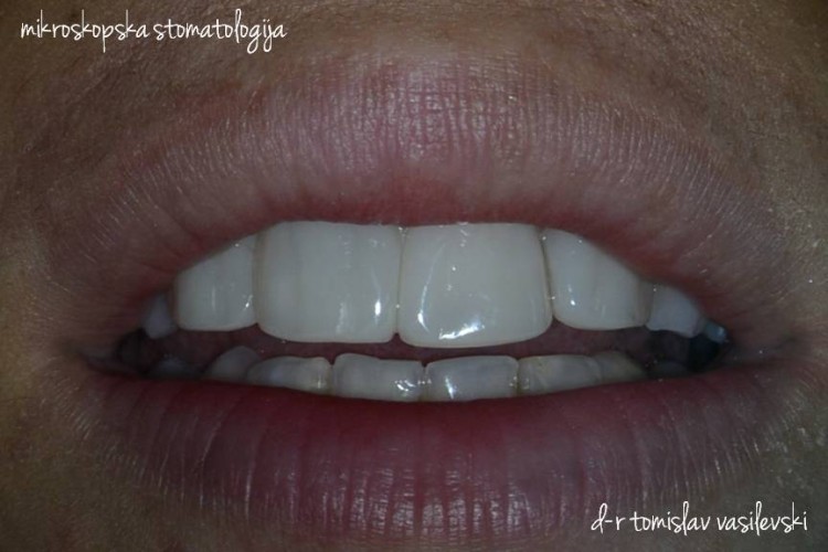 Современо естетско пломбирање на предни заби