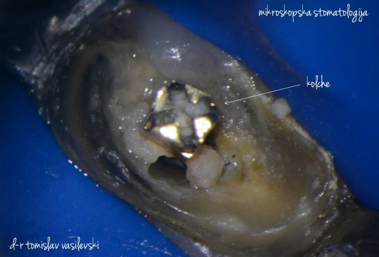 Што се наоѓа во канал на заб лекуван со класичната метода?