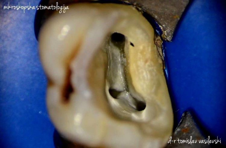 5 причини зошто да лекувате заб – „вадите живец“ микроскопски