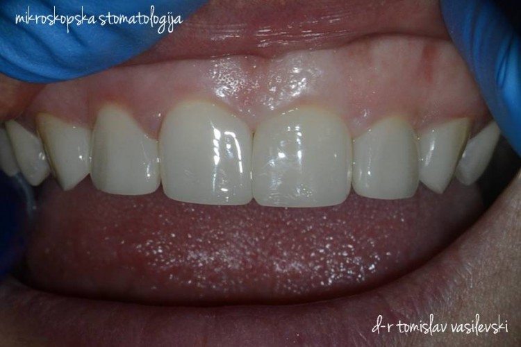 Современо естетско пломбирање на предни заби