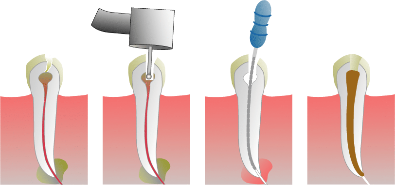 Root_Canal_Illustration