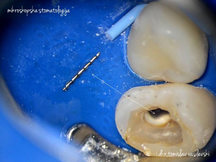 Микроскопско отстранување на скршен инструмент од канал