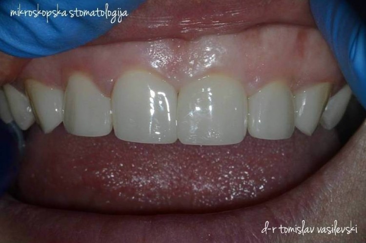 Микроскопско естетско пломбирање на предни заби без стружење!